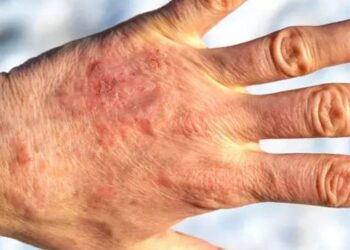 Cildinizdeki kırmızımsı ve kaşıntılı lekelere dikkat!