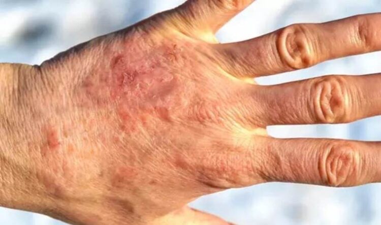 Cildinizdeki kırmızımsı ve kaşıntılı lekelere dikkat!